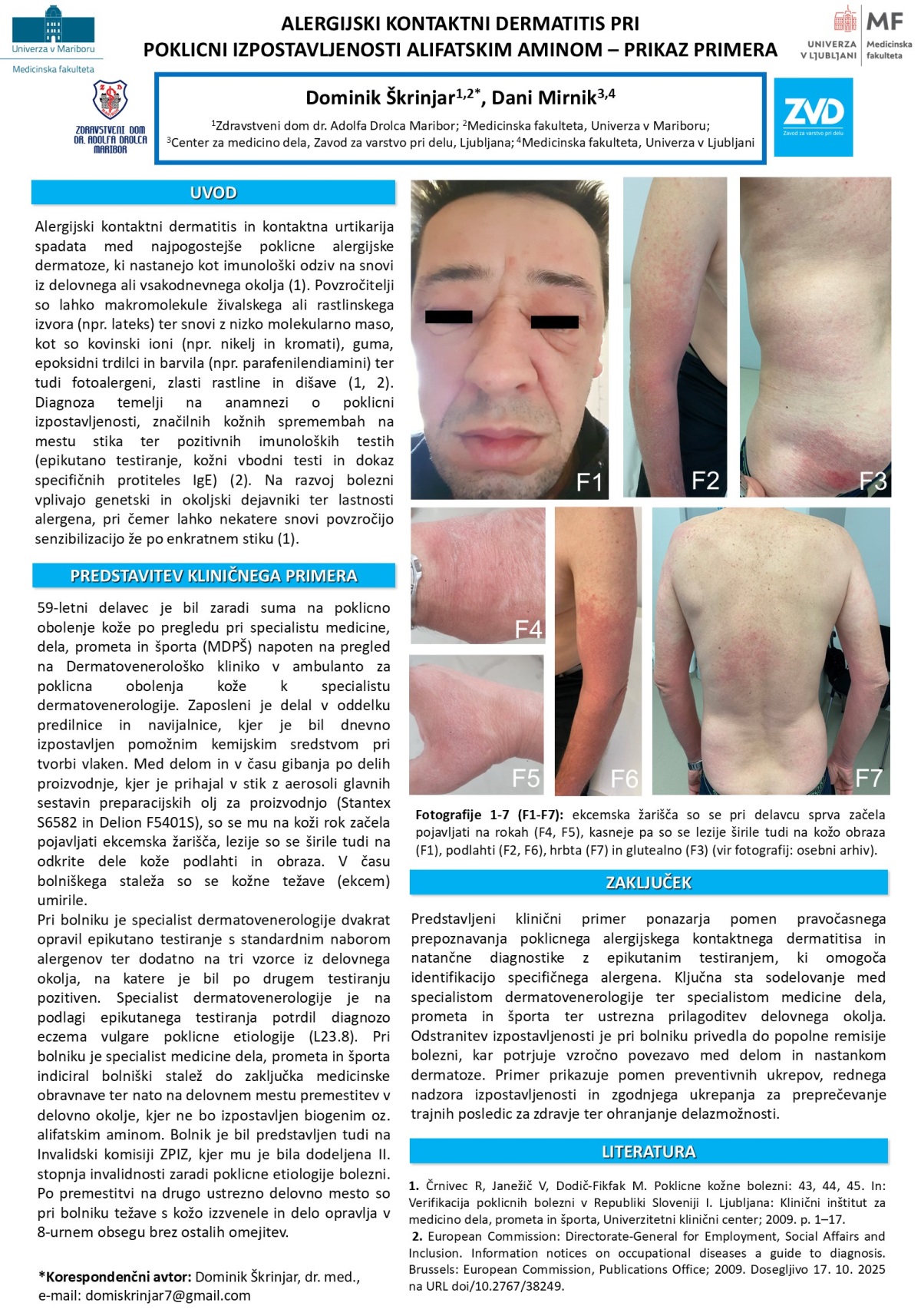 ALERGIJSKI KONTAKTNI DERMATITIS PRI POKLICNI IZPOSTAVLJENOSTI ALIFATSKIM AMINOM – PRIKAZ PRIMERA