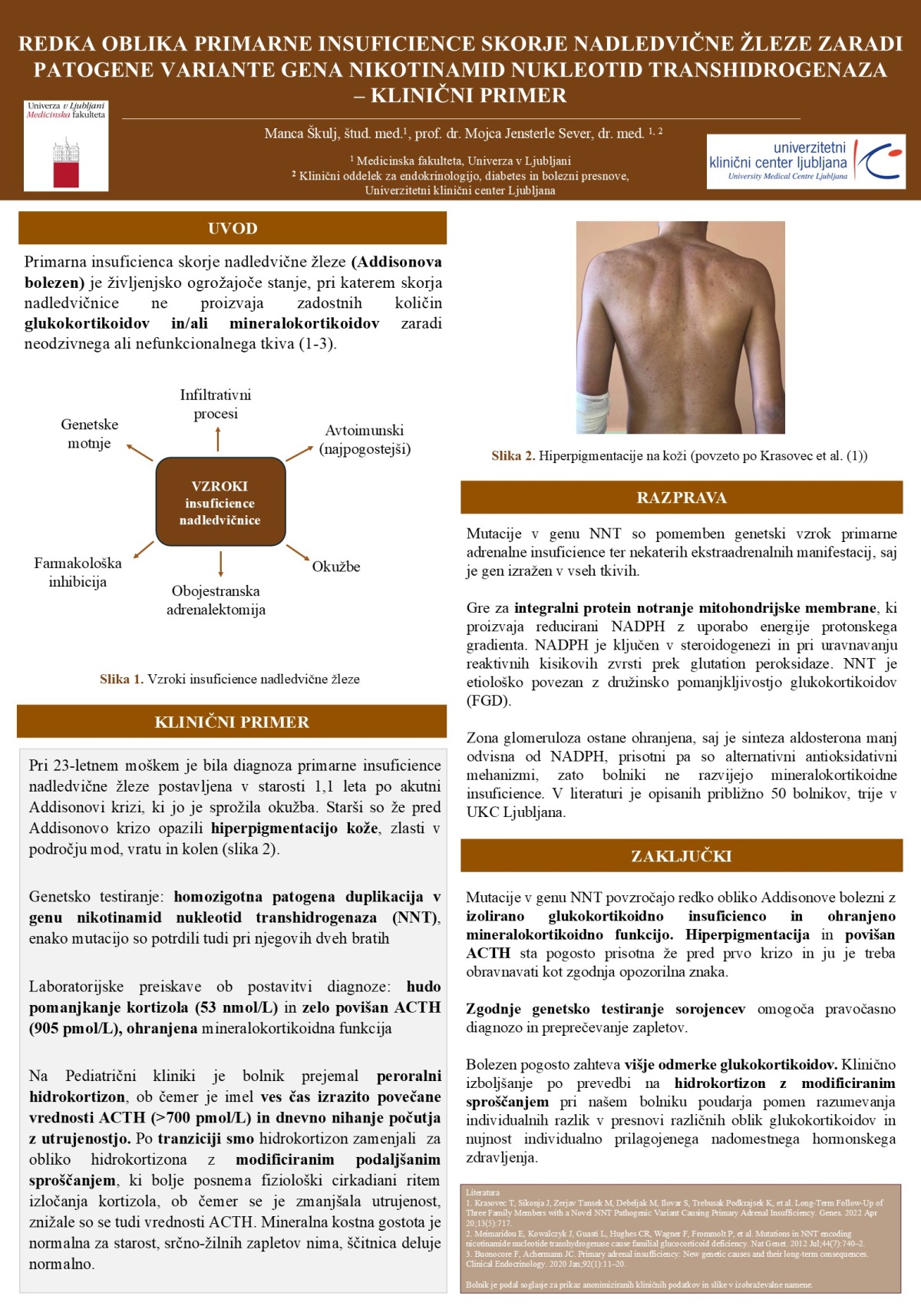 REDKA OBLIKA PRIMARNE INSUFICIENCE SKORJE NADLEDVIČNE ŽLEZE ZARADI PATOGENE VARIANTE GENA NIKOTINAMID NUKLEOTID TRANSHIDROGENAZA