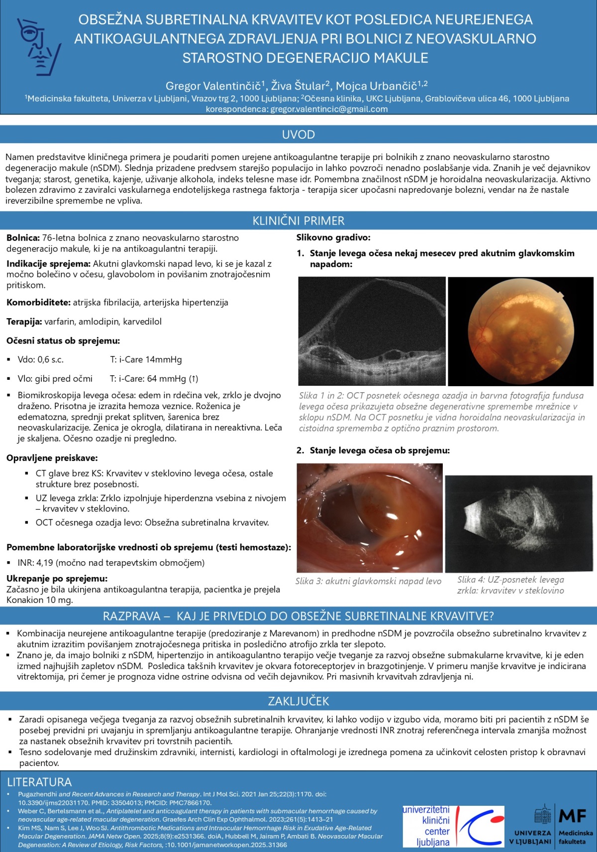 OBSEŽNA SUBRETINALNA KRVAVITEV KOT POSLEDICA NEUREJENEGA ANTIKOAGULANTNEGA ZDRAVLJENJA PRI BOLNICI Z NEOVASKULARNO STAROSTNO DEGENERACIJO MAKULE – KLINIČNI PRIMER