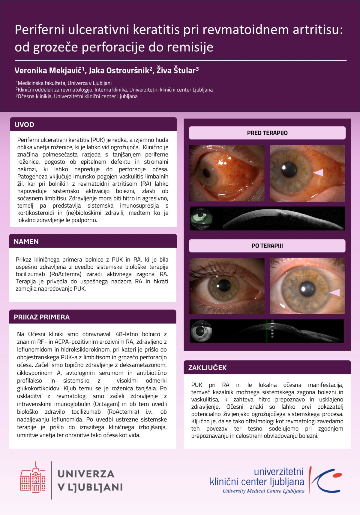 PERIFERNI ULCERATIVNI KERATITIS PRI REVMATOIDNEM ARTRITISU: OD GROZEČE PERFORACIJE DO REMISIJE – PRIKAZ PRIMERA