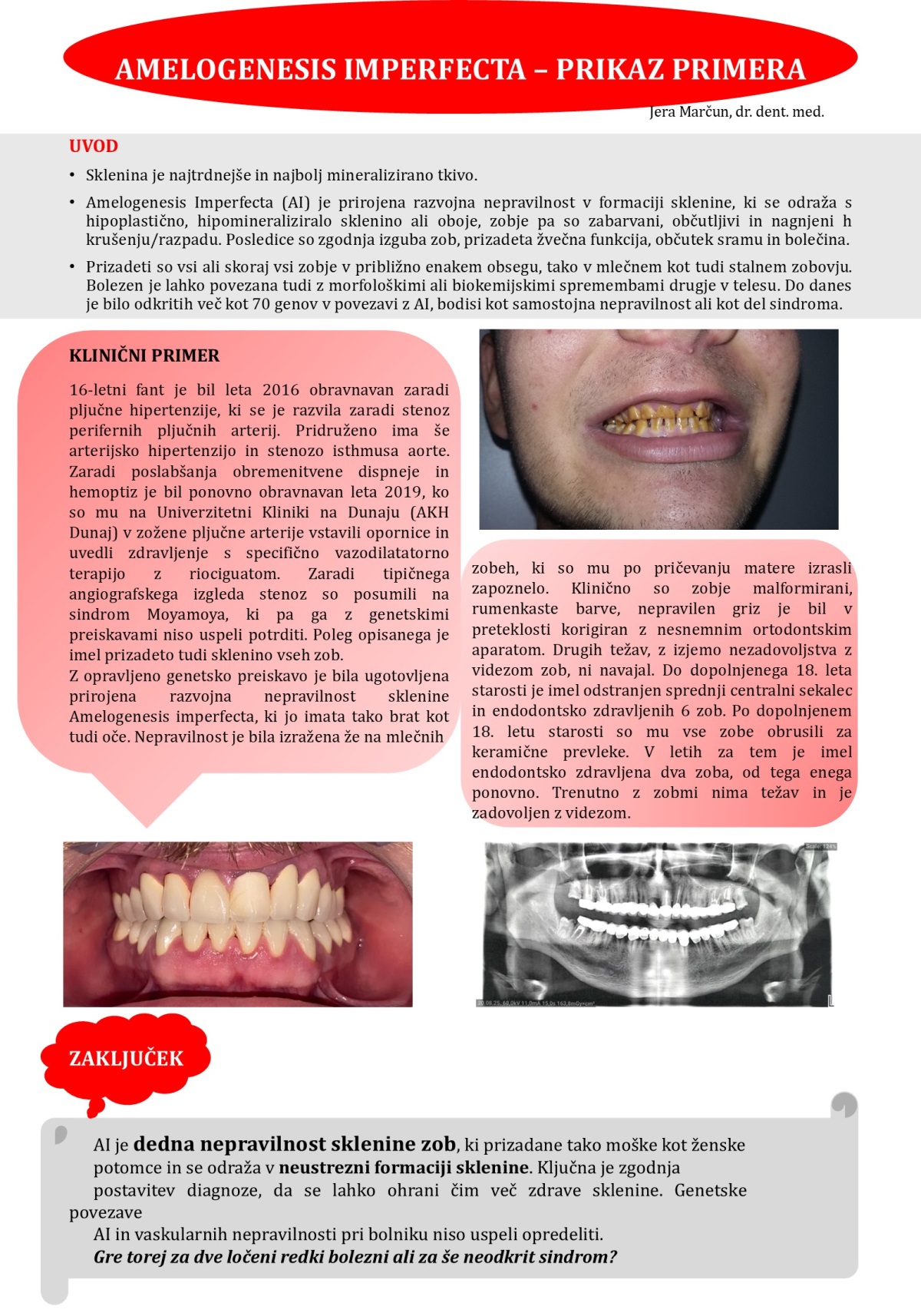 AMELOGENESIS IMPERFECTA – PRIKAZ PRIMERA