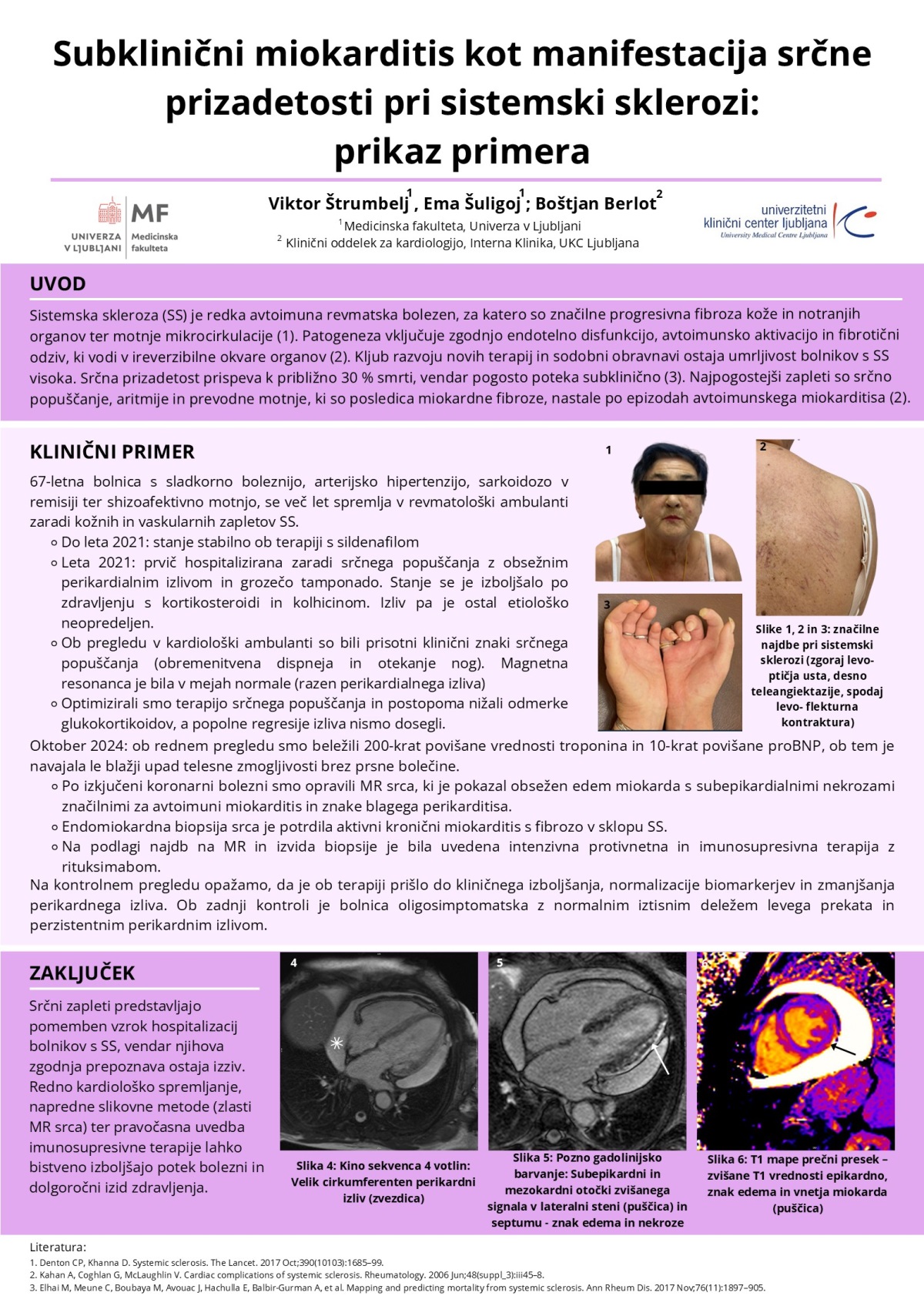 SUBKLINIČNI MIOKARDITIS KOT MANIFESTACIJA SRČNE PRIZADETOSTI PRI SISTEMSKI SKLEROZI – PRIKAZ PRIMERA