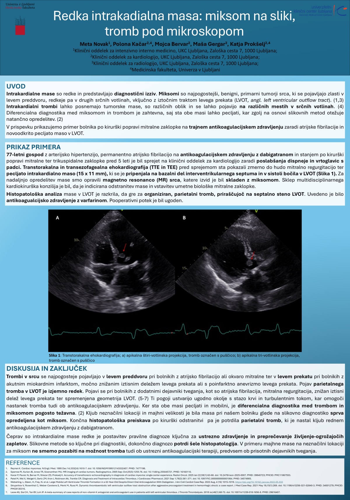 REDKA INTRAKARDIALNA MASA – MIKSOM NA SLIKI, TROMB POD MIKROSKOPOM, KLJUB ANTIKOAGULACIJSKEMU ZDRAVLJENJU