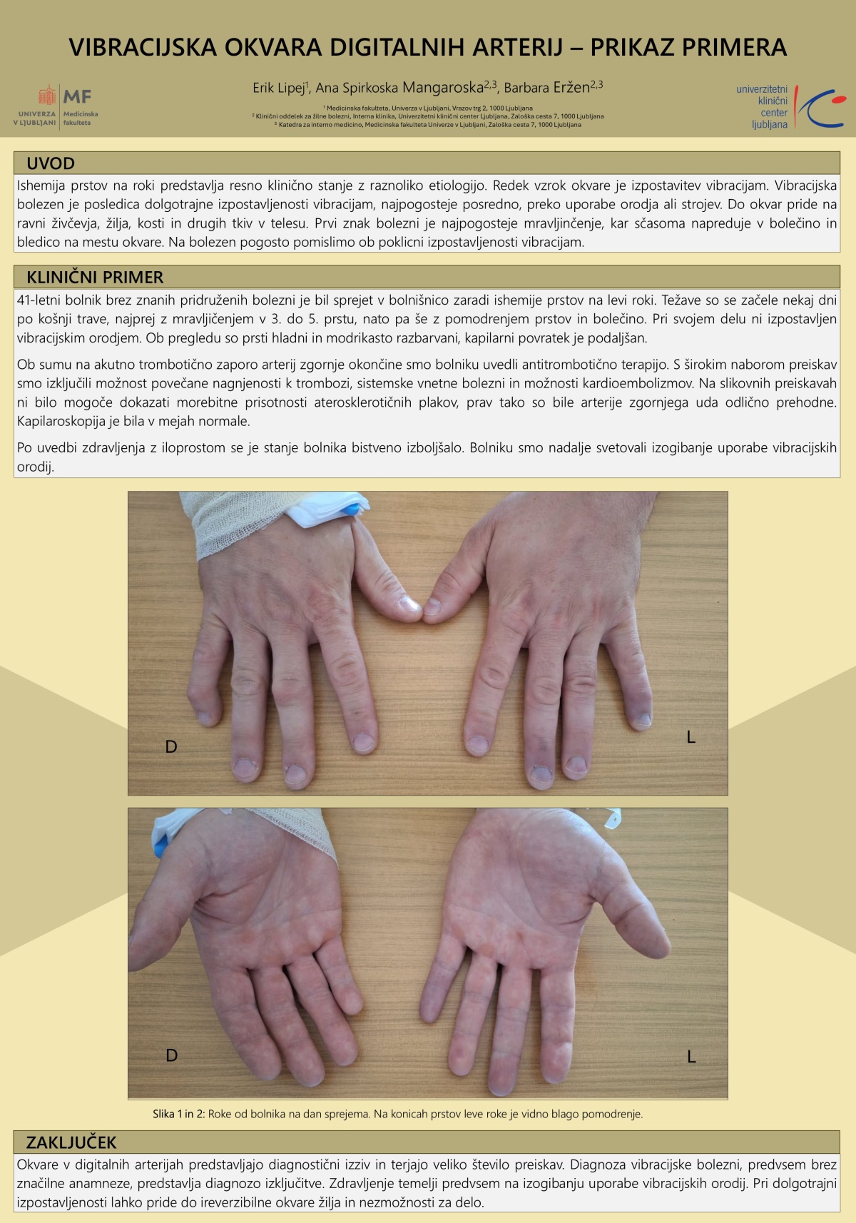 VIBRACIJSKA OKVARA DIGITALNIH ARTERIJ