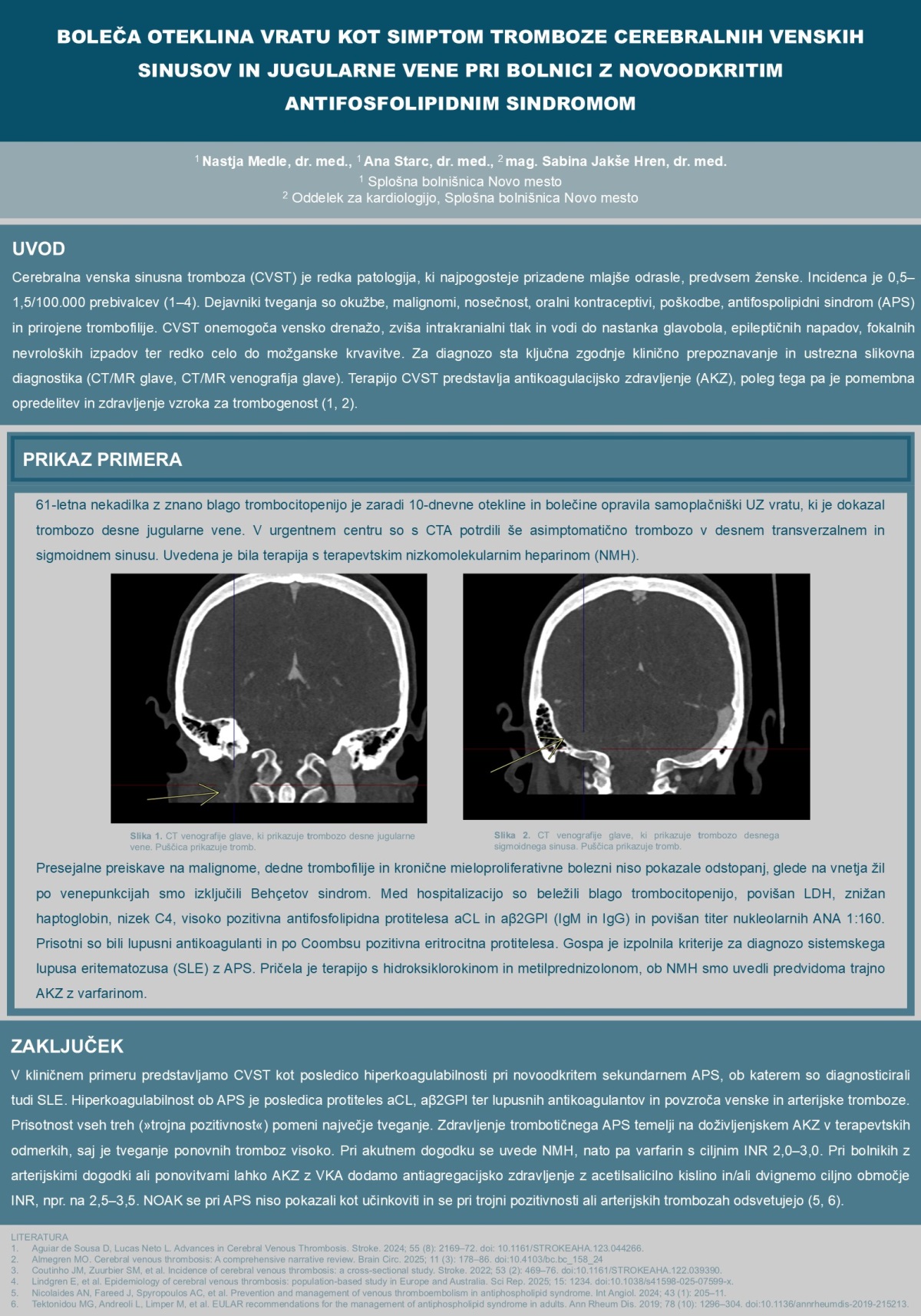 BOLEČA OTEKLINA VRATU KOT SIMPTOM TROMBOZE CEREBRALNIH VENSKIH SINUSOV IN JUGULARNE VENE PRI BOLNICI Z NOVOODKRITIM ANTIFOSFOLIPIDNIM SINDROMOM