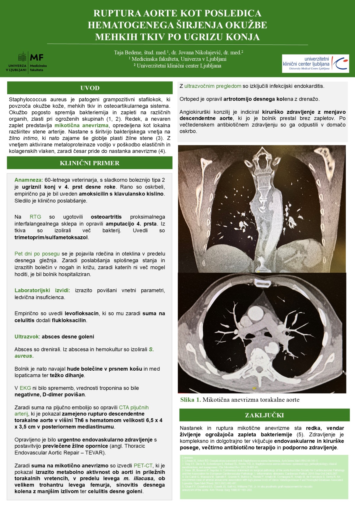 RUPTURA AORTE KOT POSLEDICA HEMATOGENEGA ŠIRJENJA OKUŽBE MEHKIH TKIV PO UGRIZU KONJA