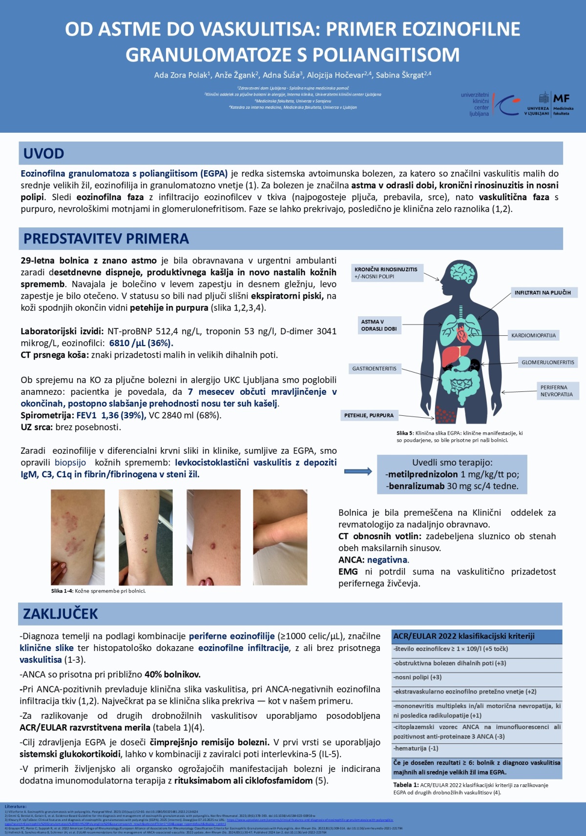 OD ASTME DO VASKULITISA – PRIMER EOZINOFILNE GRANULOMATOZE S POLIANGITISOM